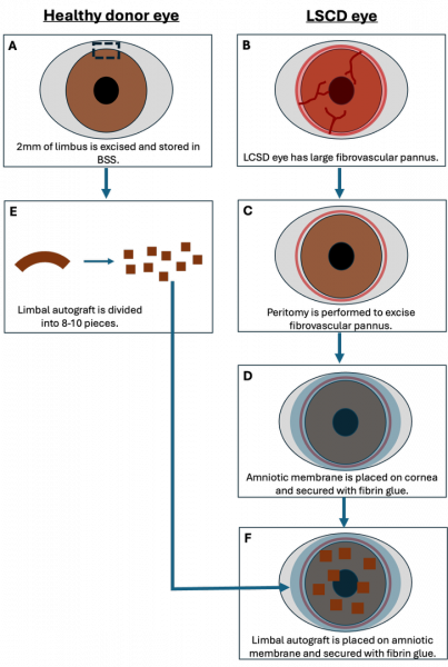 File:SLET surgery.png