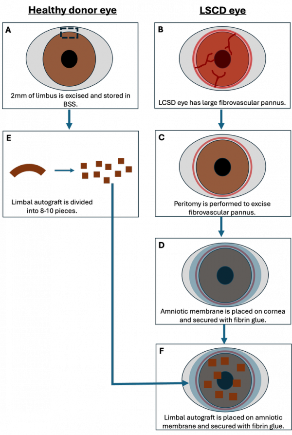 Simple Limbal Epithelial Transplantation (SLET) - EyeWiki