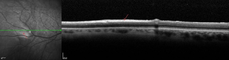 File:MRNFL IR and OCT arrows.jpg