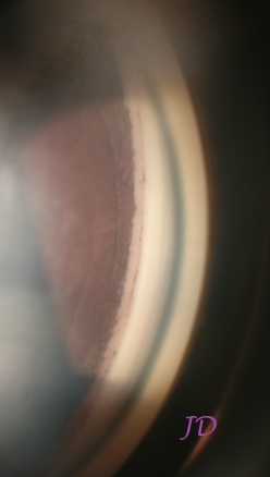 Smartphone Gonioscopy Photograph taken through a GM2M goniomirror and slitlamp by Dr John