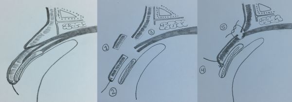 Entropion - EyeWiki