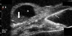 Figure 5A. UBM longitudinal scan demonstrates an elevated, round cystic lesion at the limbal area, filled by hyporeflective content (*) and an inferior deposit of punctiform particles (thick arrow). Note highly reflective deposit at the angle, endothelial line, and iris surface (thin arrow). (Courtesy of Norma Allemann, PhD. Department of Ophthalmology, Federal University of São Paulo, Brazil.)
