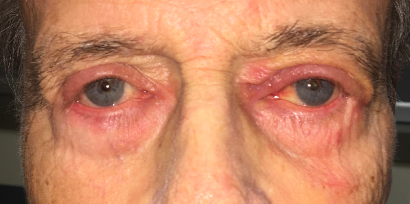 File:Periocular Dermatitis.png