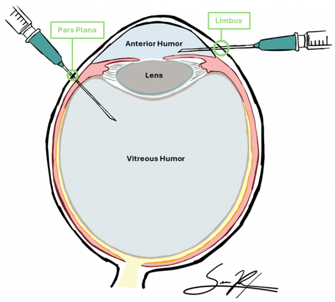 File:Aqueous and Vitreous Sampling.png