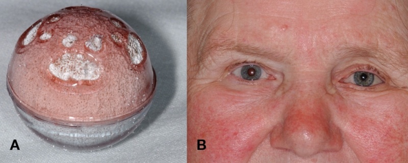 File:Fig04 eyewiki.jpg