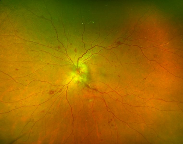 File:Fundus Photo.png
