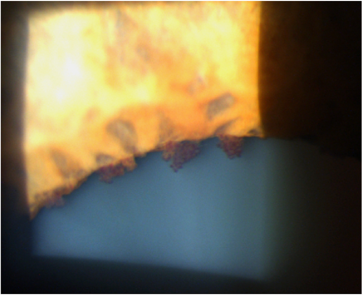 File:Iris Microhemangioma.png