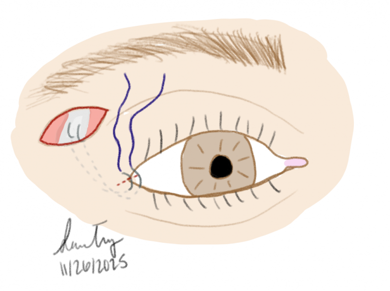 File:Lateral Retinacular Suspension.png