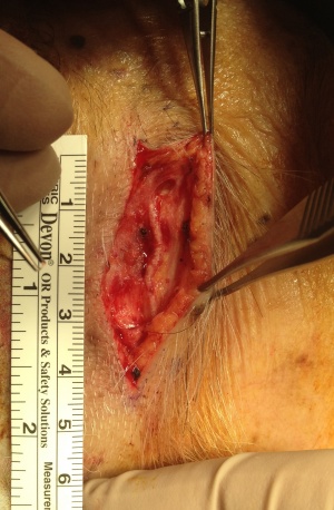 Initial intraoperative appearance of a temporal artery biopsy. The ruler along the left side is located posteriorly in this case. The incision is made posterior to the hairline (hair shaved) to avoid damage to the temporalis branch of the facial nerve. The right superficial temporal artery is clearly seen prior to complete dissection and biopsy. Except for grossly visible age-related calcification, the intraoperative appearance of the vessel was otherwise normal. The histopathology confirmed a negative result. Image courtesy of Marcus M. Marcet, MD FACS