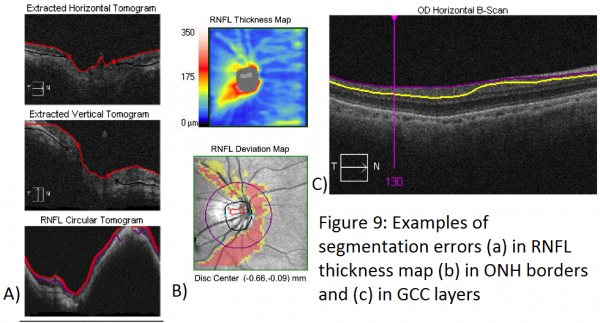 Spectral Domain Optical Coherence Tomography in Glaucoma - EyeWiki