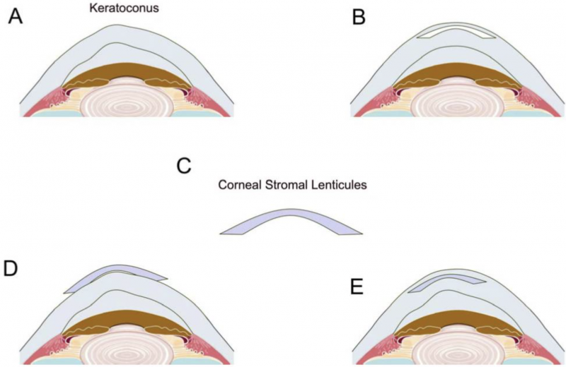 File:Keratoconus SmileApp.png