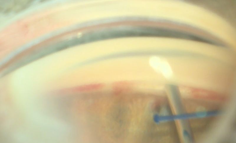 File:Fig.7 ovd into goniotomy.jpg