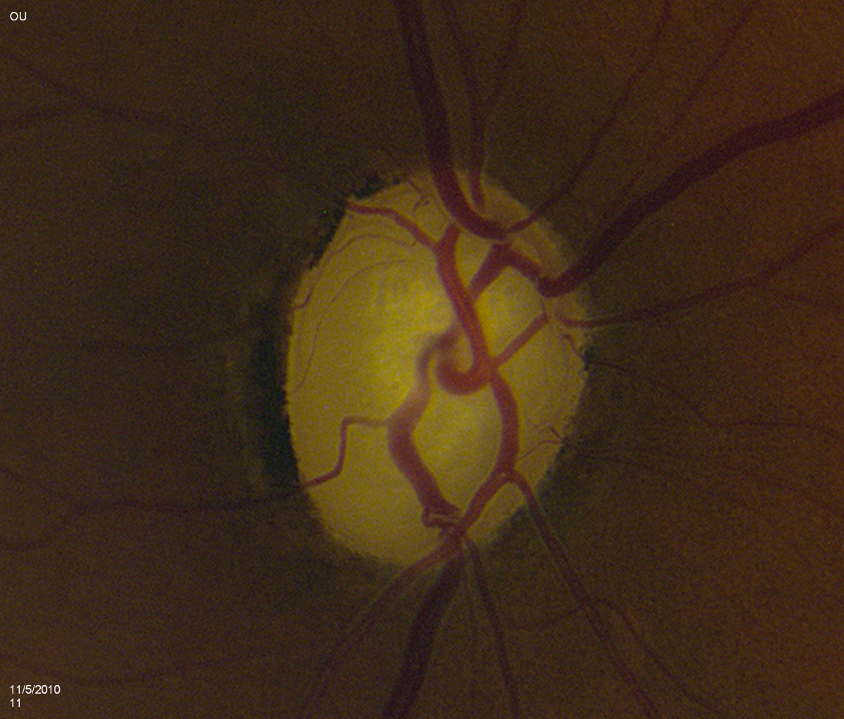 Examination of the Optic Nerve at the Slit-Lamp Biomicroscope with a ...