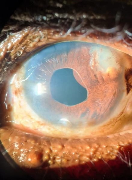 File:Iris cyst 2.jpeg