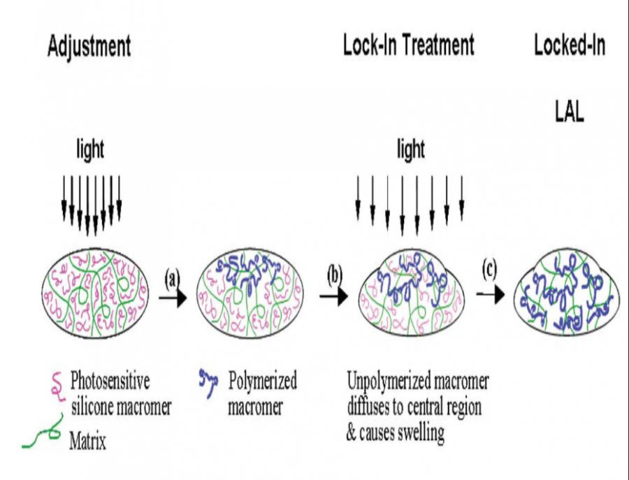 Light Adjustable Intraocular Lenses - EyeWiki