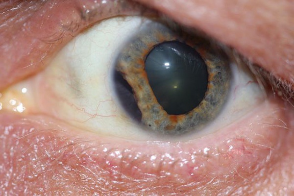 Seven Rings of Trauma - EyeWiki