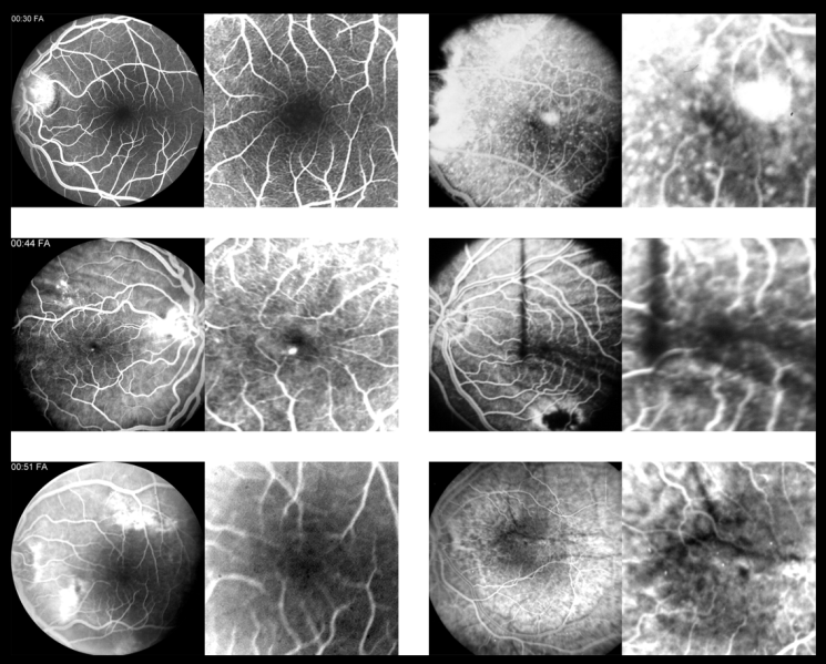 File:Increased FAZ nanopthalmos.png