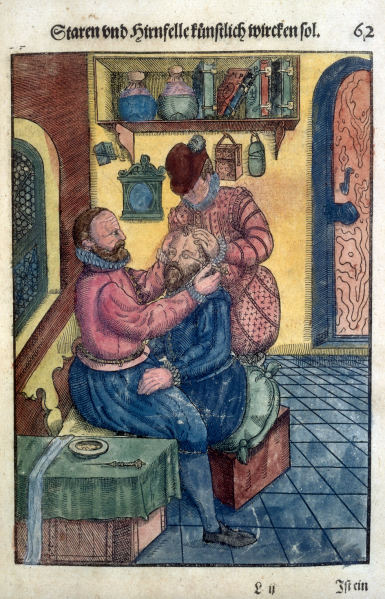 File:Cataract Couching2.png