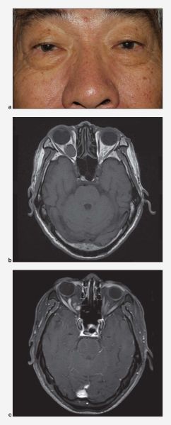 File:Cavernous hemangioma FocalPoints.jpg