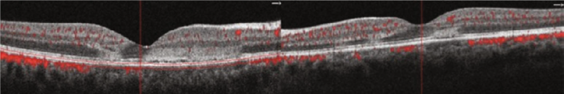 File:APMPPE SD-OCT.png