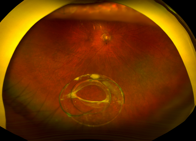 File:IOL-Capsular Bag Complex Dislocation.png