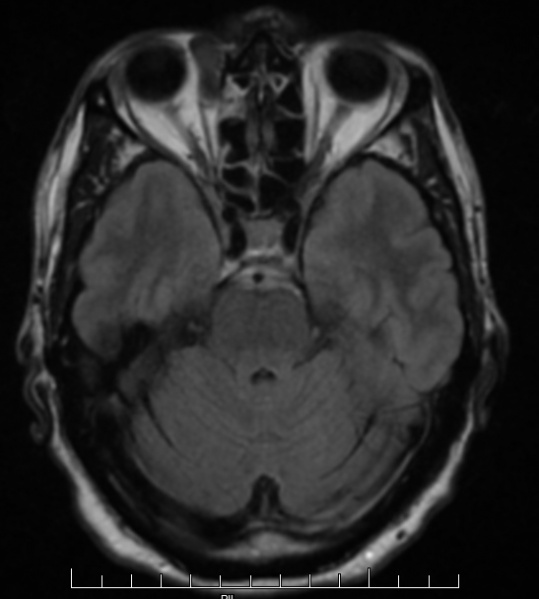 File:MRIAxial.jpg