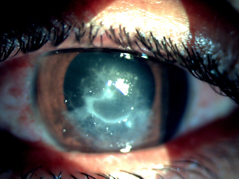 File:Pythium keratitis.jpg