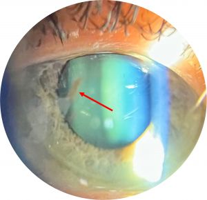 Spoke-Like Capsule Pigment Deposition on Posterior Lens Capsule in Pigment Dispersion Glaucoma
