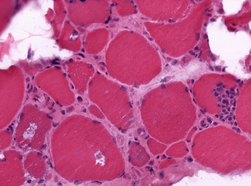 File:IBM rimmed vacuoles HE x200.jpg