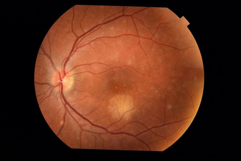 File:Macular I CNV.jpg