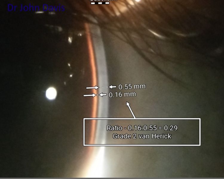 File:Van-herrick grading system.jpg