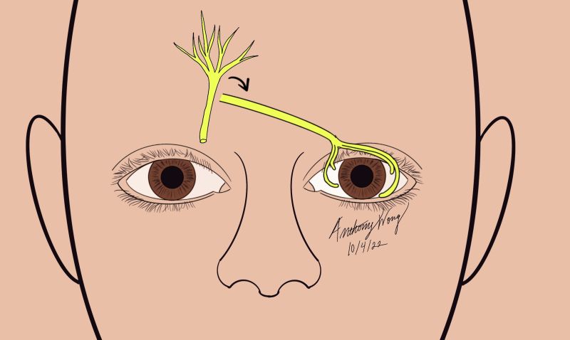 File:Direct contralateral.jpg