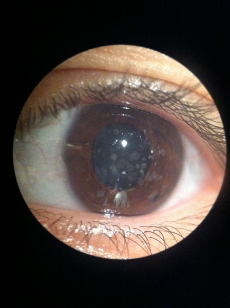 File:Granular Dystrophy Photo--Feldman.jpg
