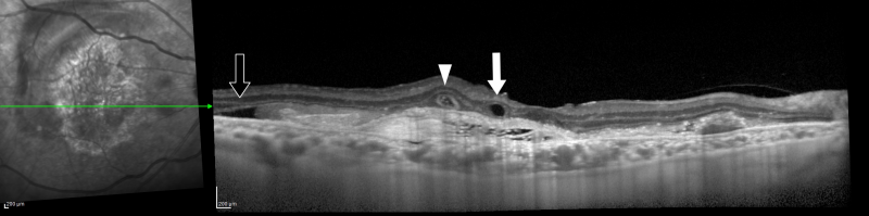 File:Outer Retinal Tubulation.png