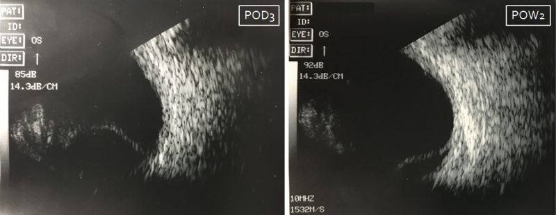 File:Choroidal Effusion.png