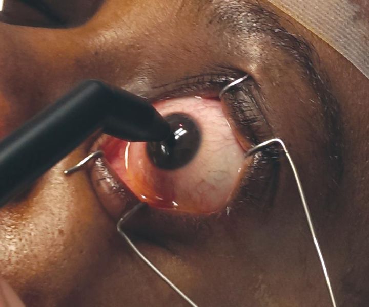 File:Crosslinking surgical technique.jpg