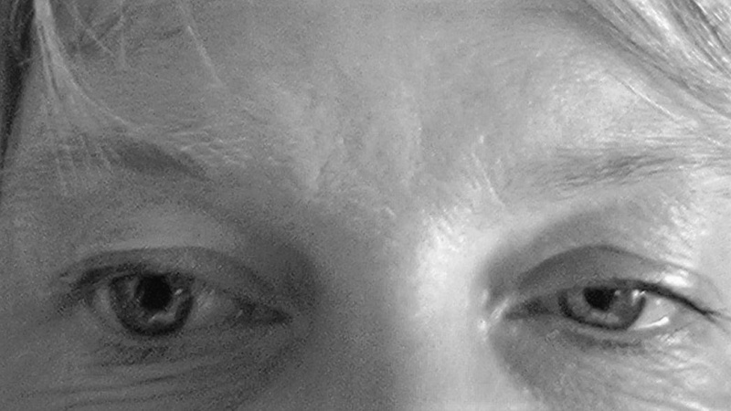 File:Horner syndrome.jpg