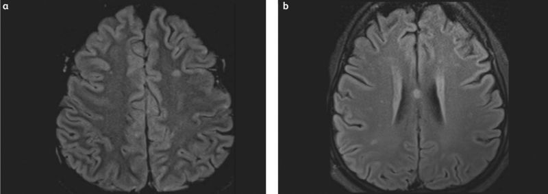 File:Nipah Virus MRI Findings.jpg