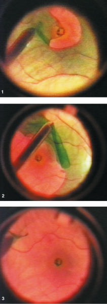 File:ILM Peel with ICG 2.png