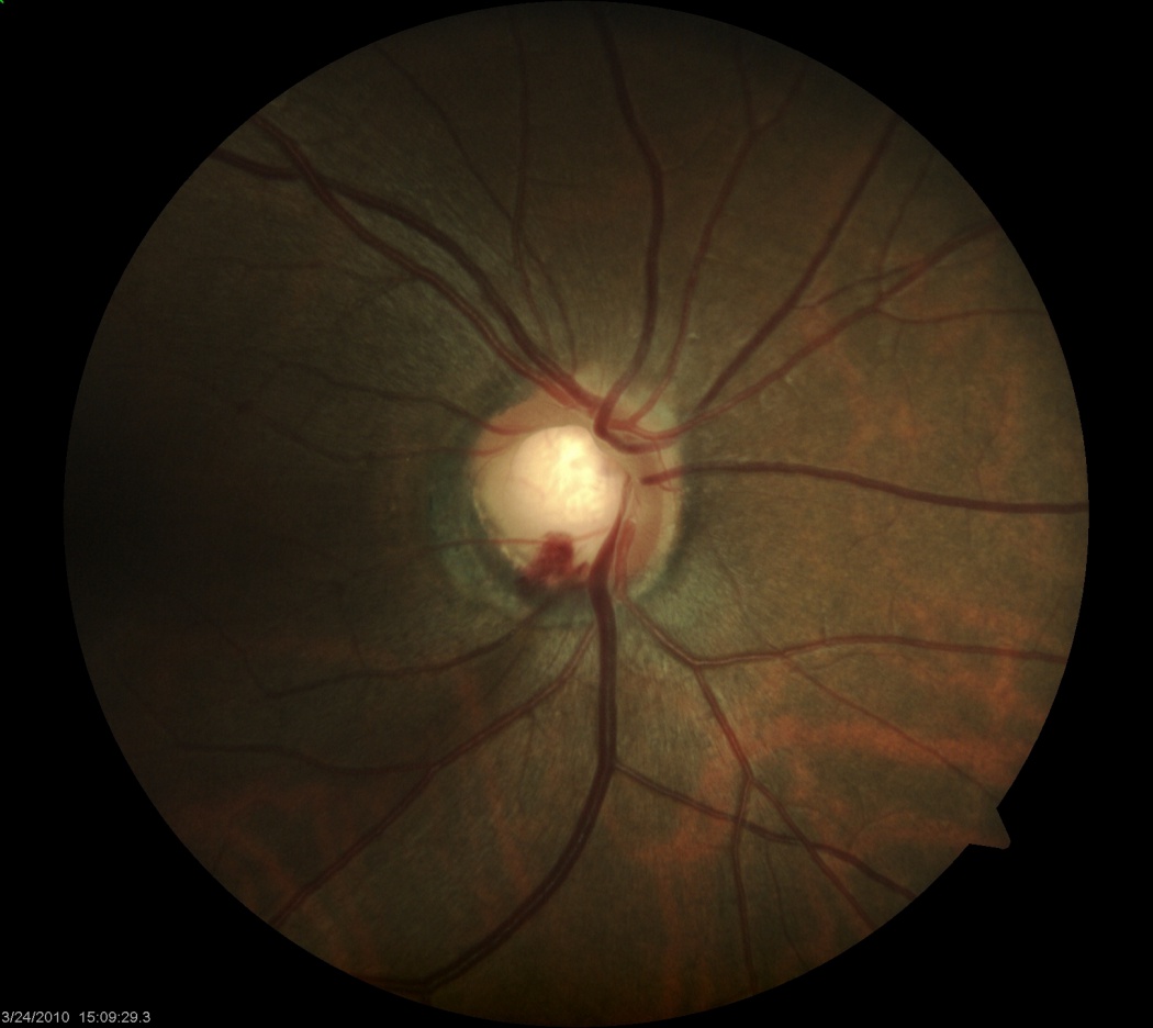 Examination of the Optic Nerve at the Slit-Lamp Biomicroscope with a ...