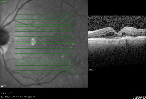 Cystoid Macular Edema - EyeWiki