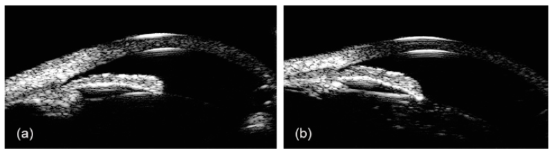 File:Outflow Pathway Imaging Figure 2.png