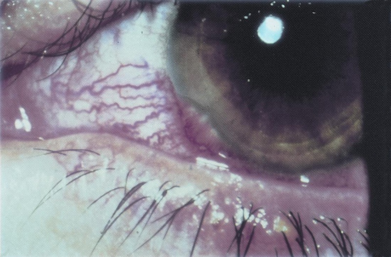 File:Phlyctenules Staphylococcal blepharitis.jpg