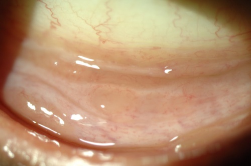 Figure 1: Conjunctival nodules secondary to sarcoidosis