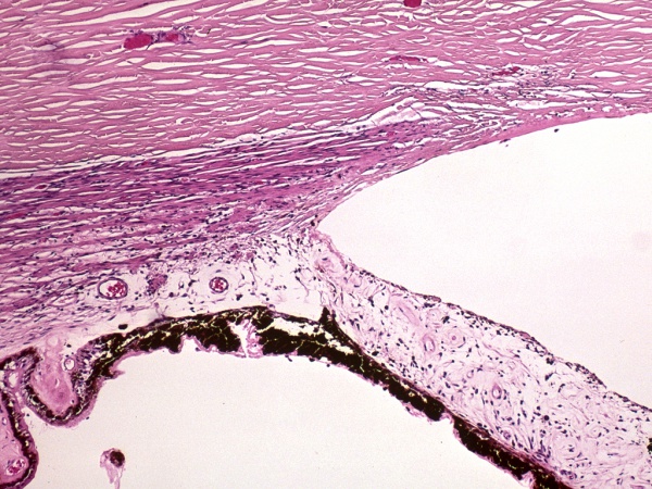 Angle Recession Glaucoma - EyeWiki
