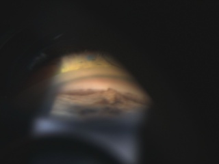 PAS in a Patient With ICE Syndrome