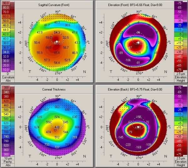 Keratoconus - EyeWiki
