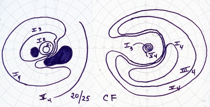 Bilateral visual field defect in a CAR patient