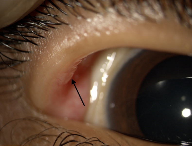 File:MEN lid neuroma.jpg