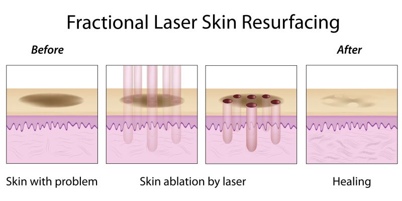 File:Fractional Laser Skin Resurfacing.jpg